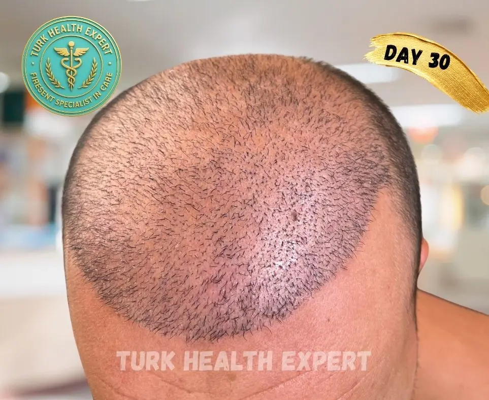 FUE Turquía día 7 — zona receptora costras normales
