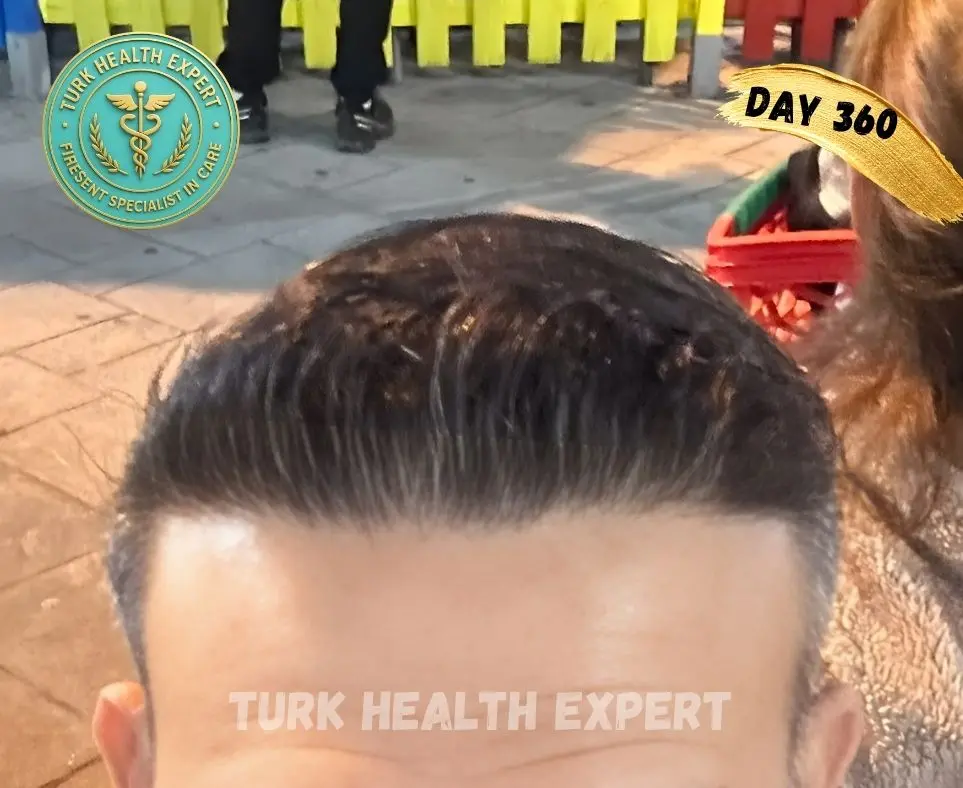 FUE Turquía día 7 — zona receptora costras normales