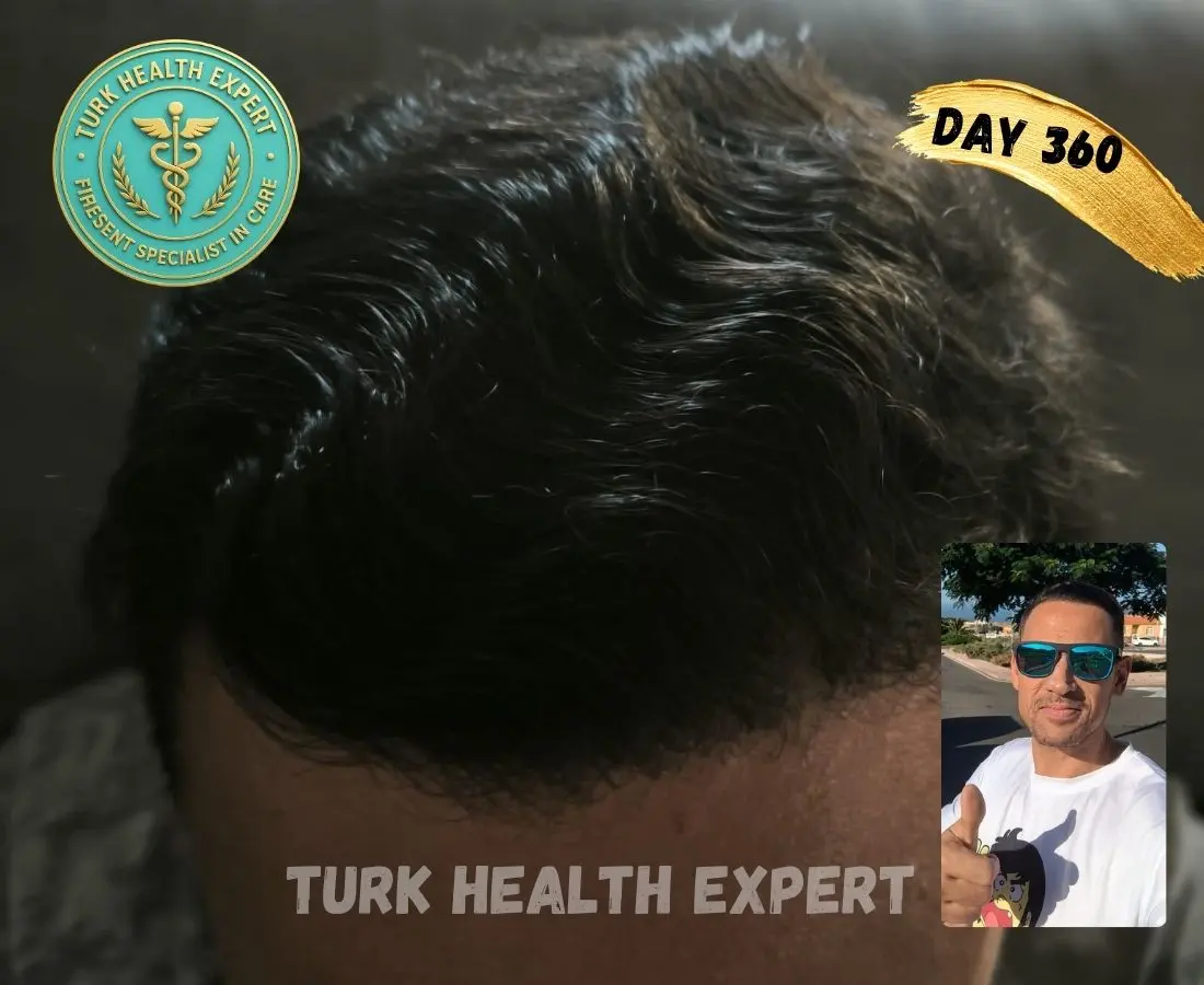 Résultat définitif greffe de cheveux Turquie — Mois 12 : résultat permanent et naturel