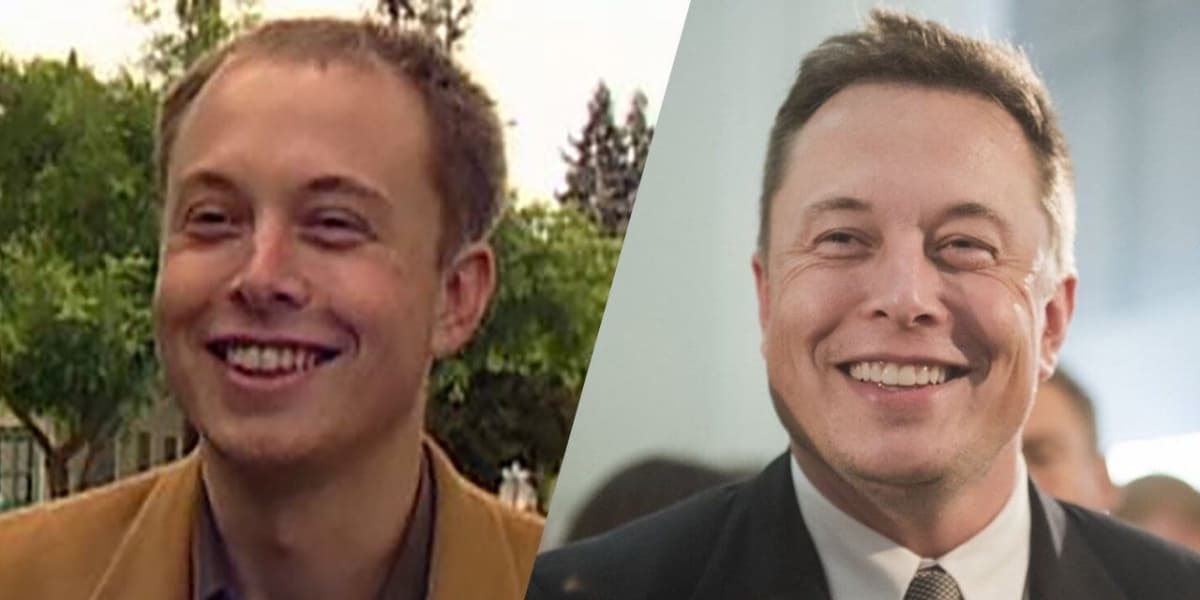 Justin Bieber before — early hairline recession