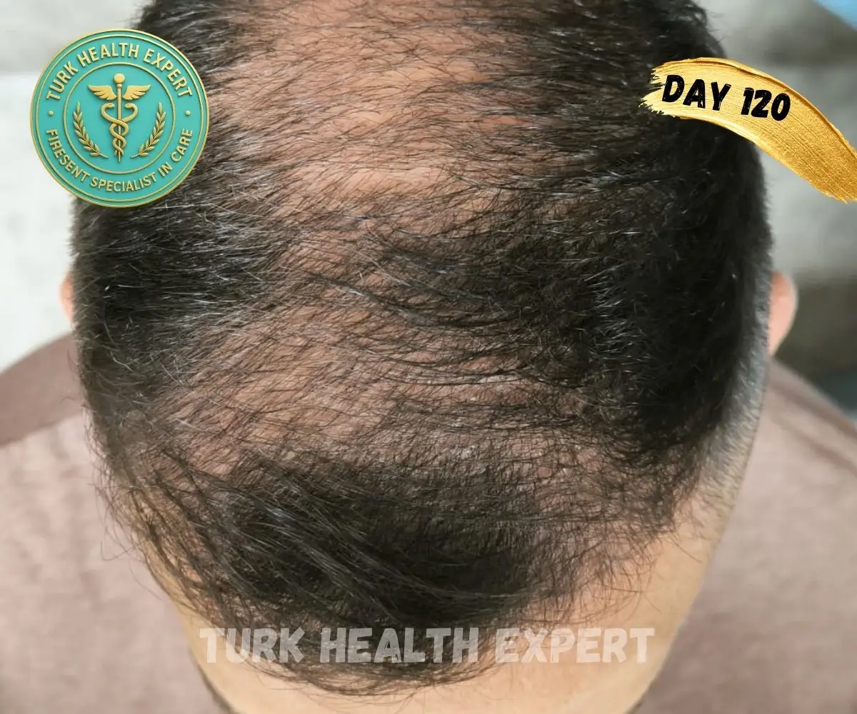 Résultat greffe de cheveux Turquie — Mois 5 : densité capillaire visible