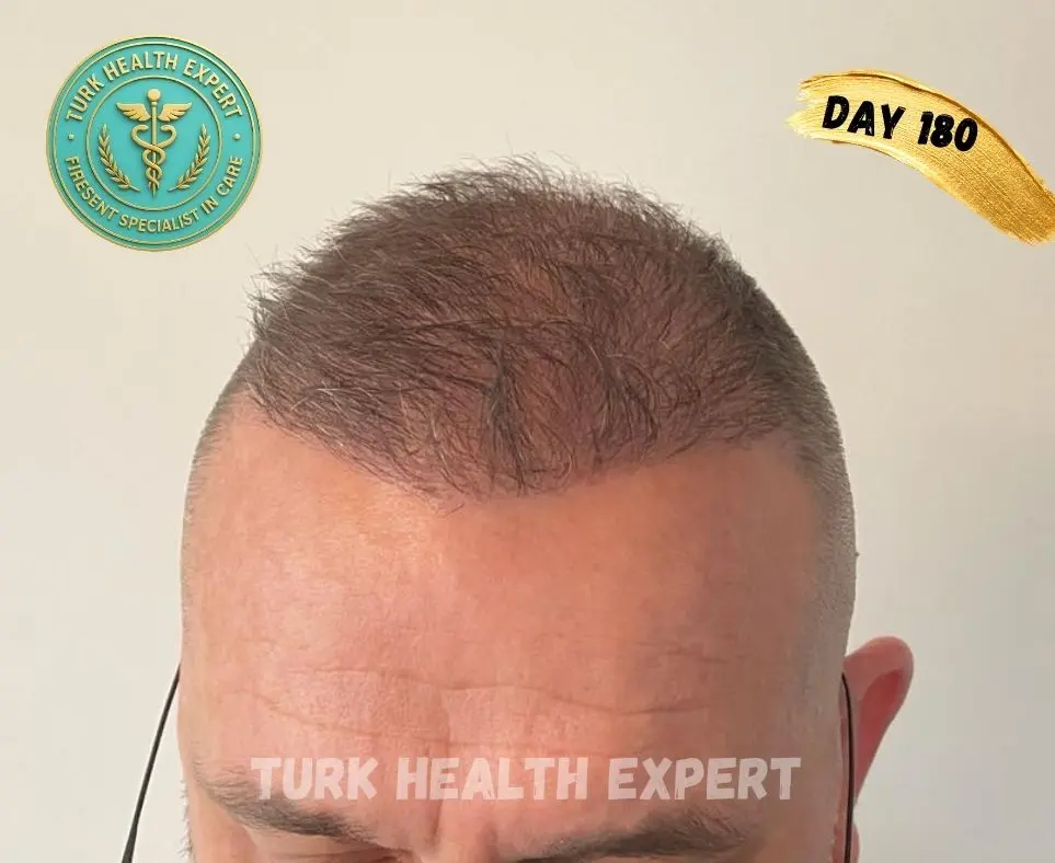 FUE Turquía día 7 — zona receptora costras normales