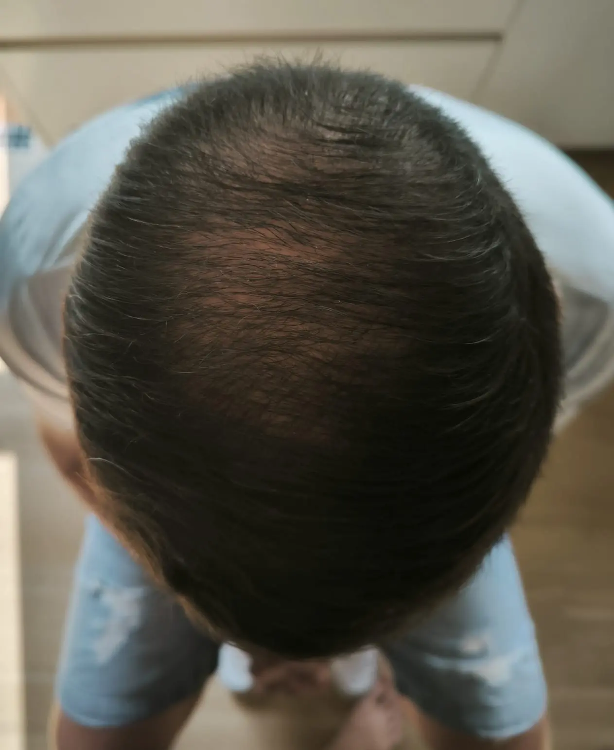 Résultat greffe de cheveux Turquie — Mois 6 : 60% du résultat final