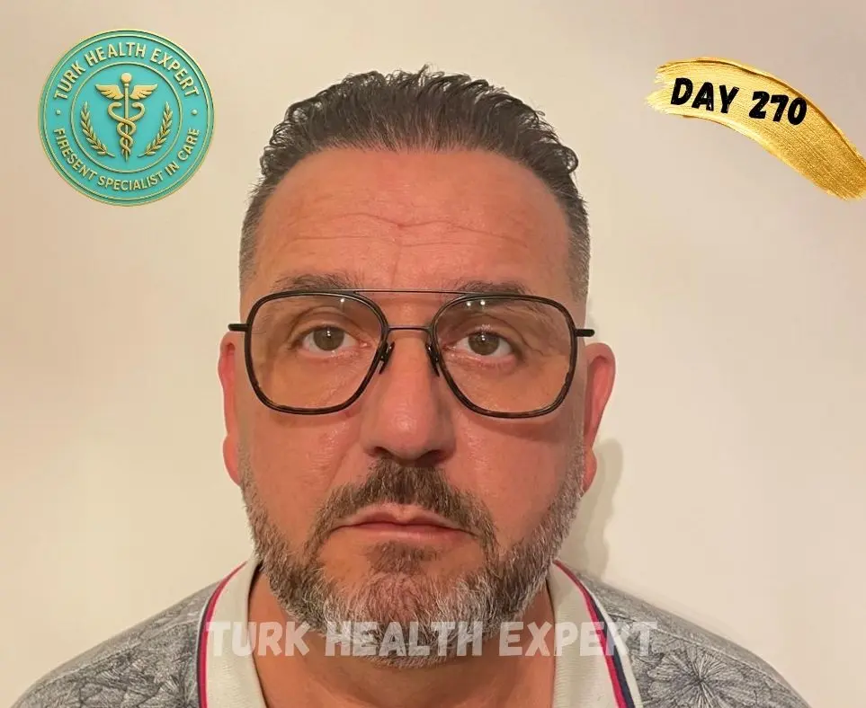 FUE Turquía día 7 — zona receptora costras normales