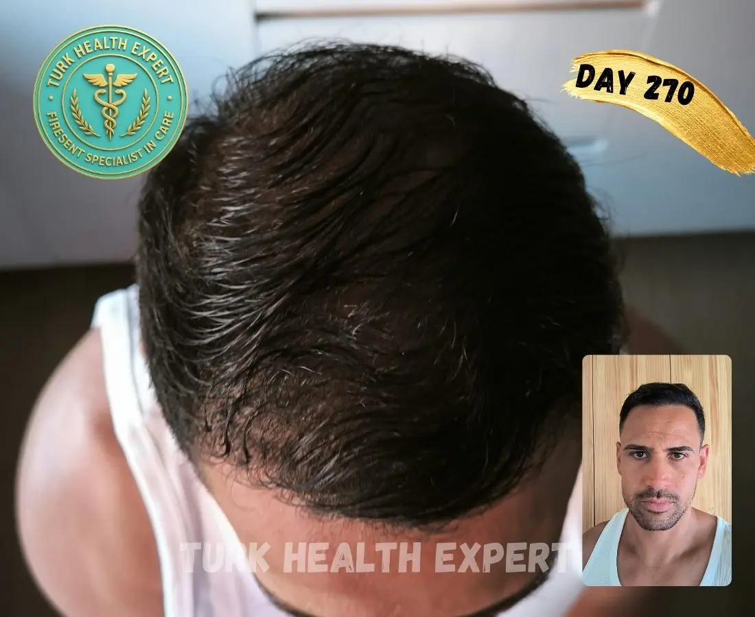 Résultat greffe de cheveux Turquie — Mois 9 : 80% de densité finale