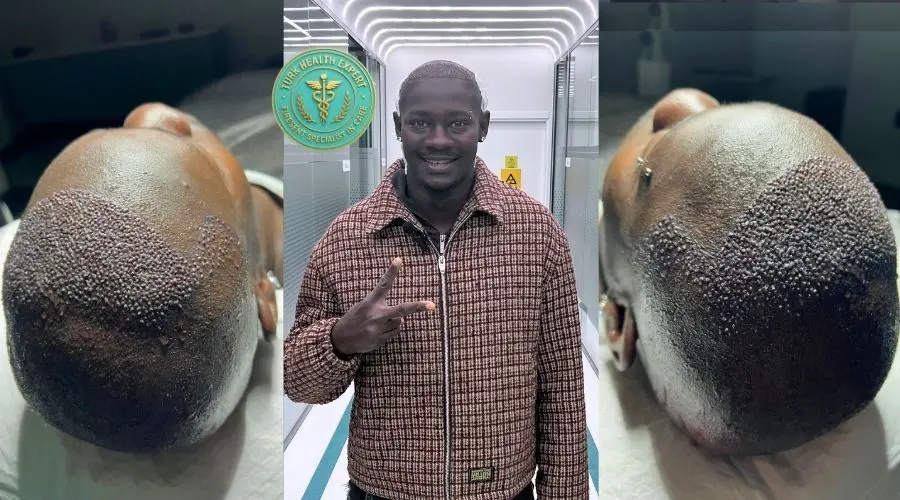 Karim avant greffe FUE Istanbul — Norwood 5 calvitie frontale et vertex