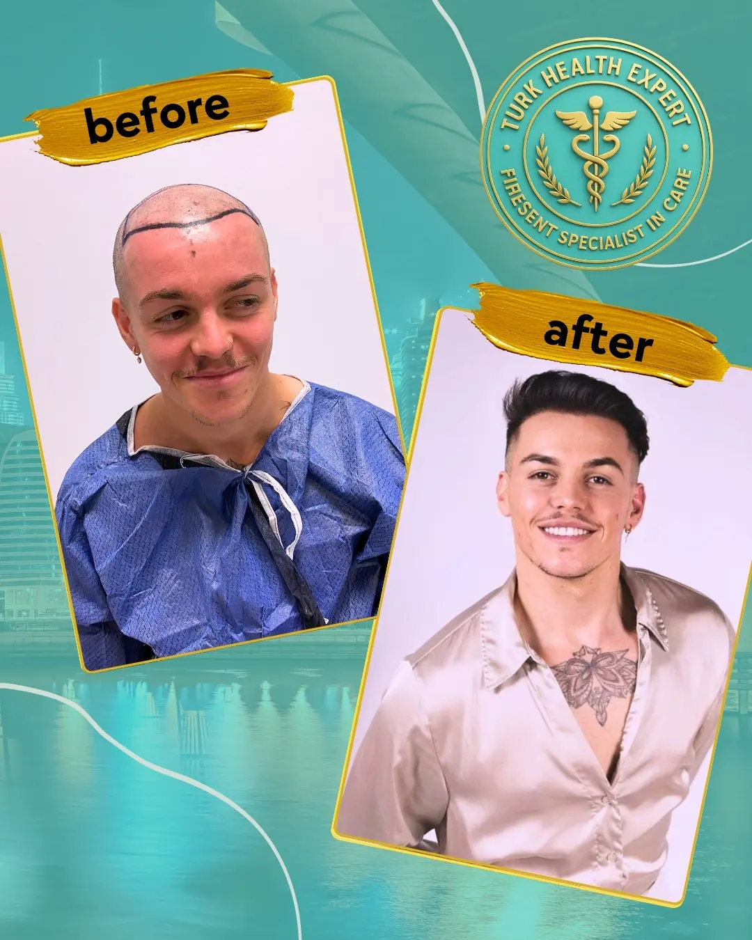 Dr. Zekeriya Türk — greffe de cheveux FUE Saphir à Istanbul, lame de saphir en main