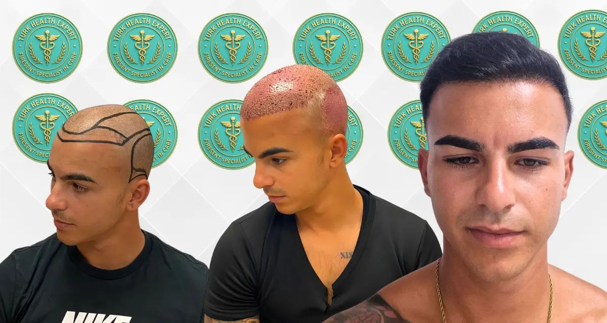 Hair transplant Istanbul checklist 2026 — passport suitcase medical documents preparation