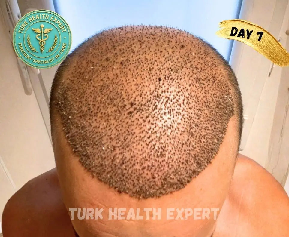 FUE Turquía día 7 — zona receptora costras normales