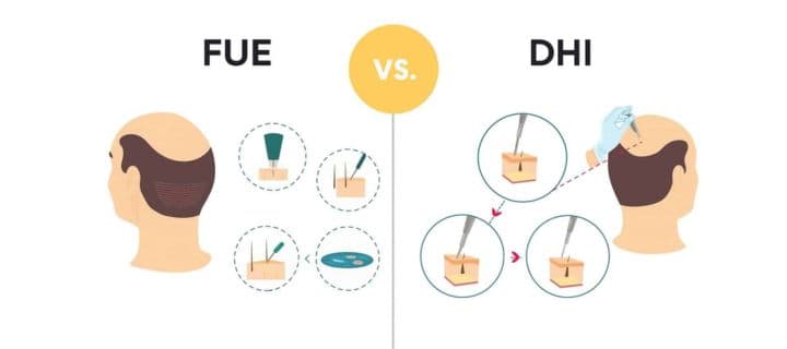 DHI vs FUE hair transplantation