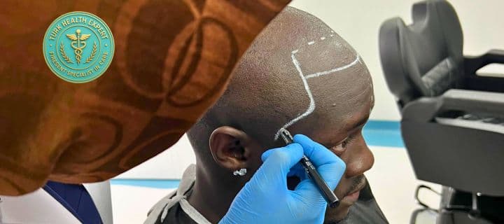 afro african hair transplant