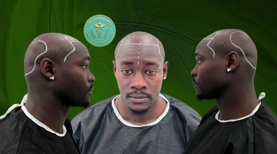 Karim avant greffe FUE Istanbul — Norwood 5 calvitie frontale et vertex