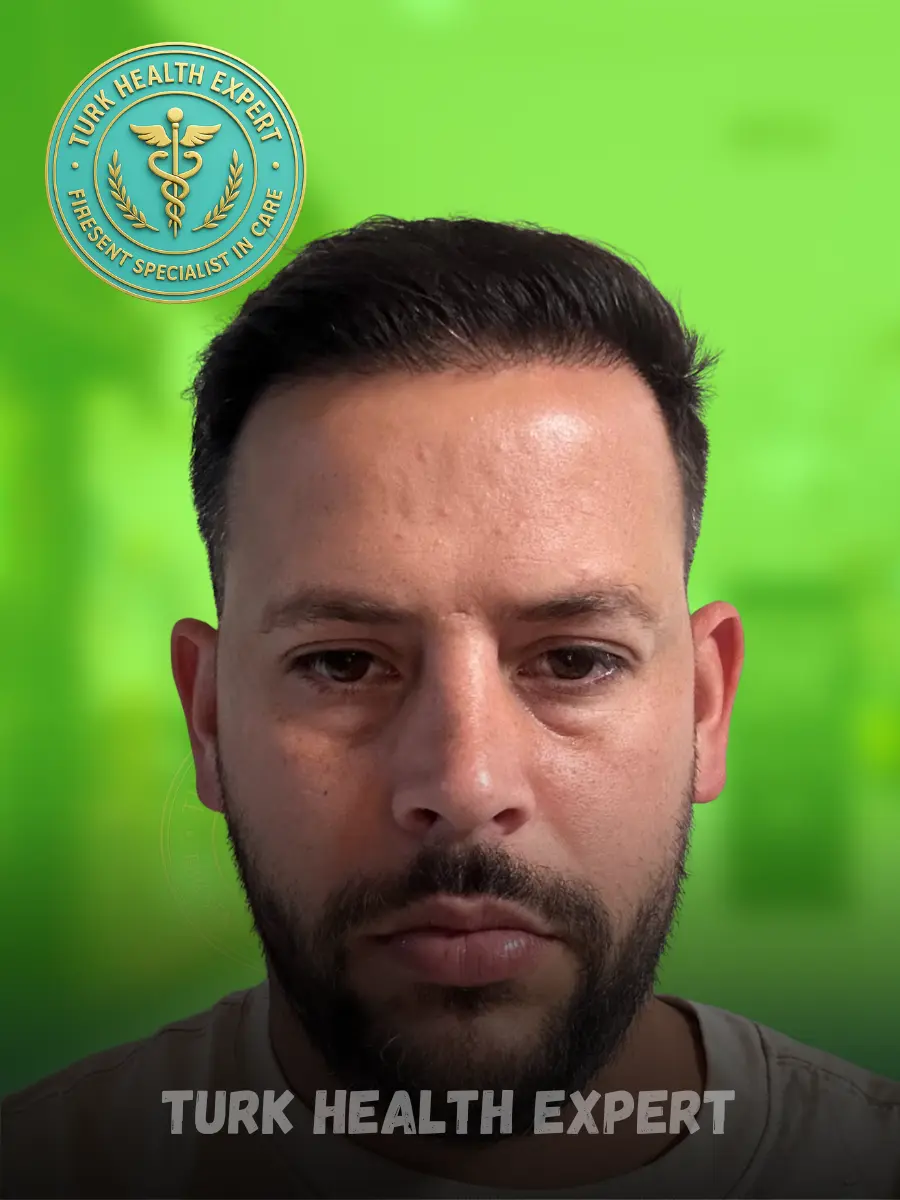 Rodrigo después trasplante FUE Turquía — resultado 16 meses