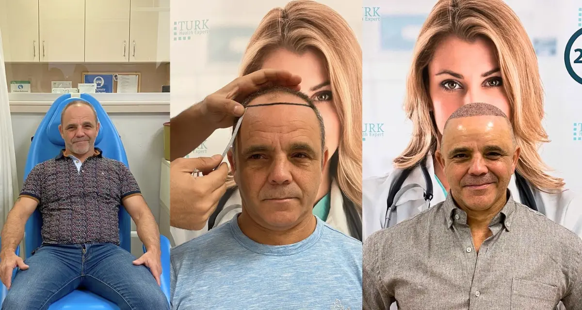 Estafas trasplante capilar Turquía — cómo identificar clínica seria vs low-cost en 2026