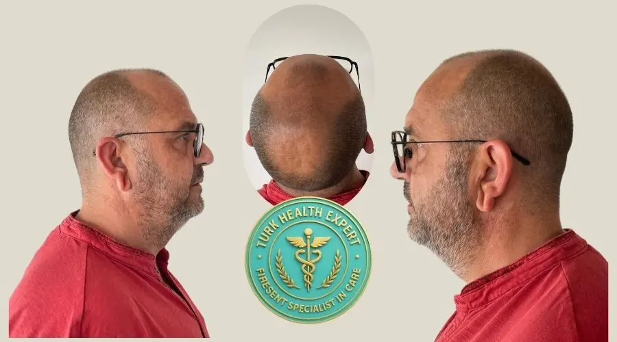 Karim avant greffe FUE Istanbul — Norwood 5 calvitie frontale et vertex