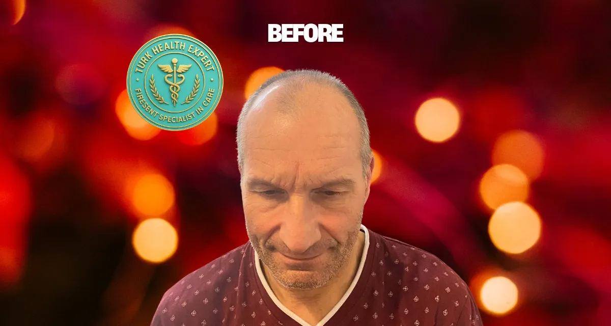 Avant DHI sans rasage Istanbul — Samira 38 ans Bruxelles, alopécie