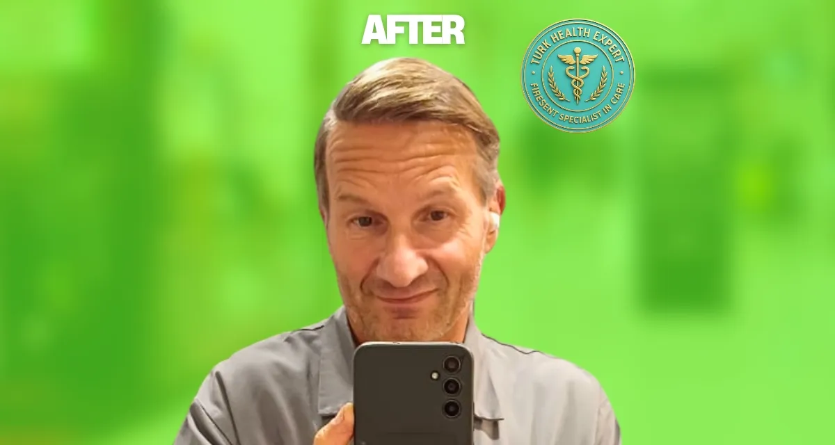 Après DHI sans rasage Istanbul 12 mois — Samira 38 ans Bruxelles, résultat naturel