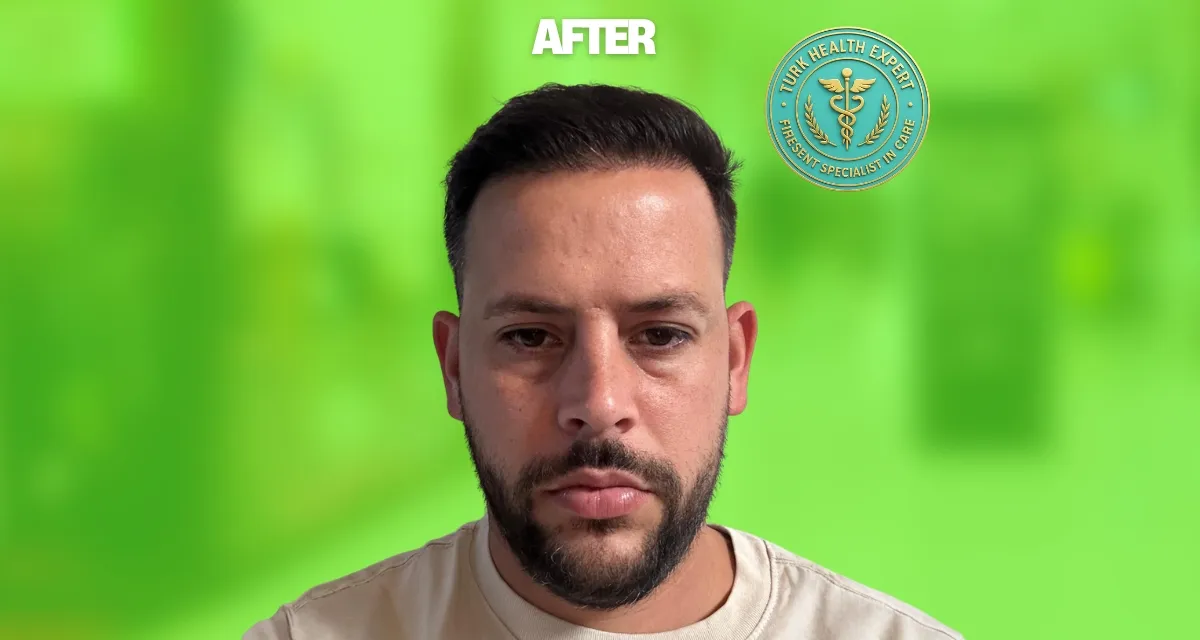 Après greffe DHI Istanbul 12 mois — Karim 34 ans Lyon, densité complète