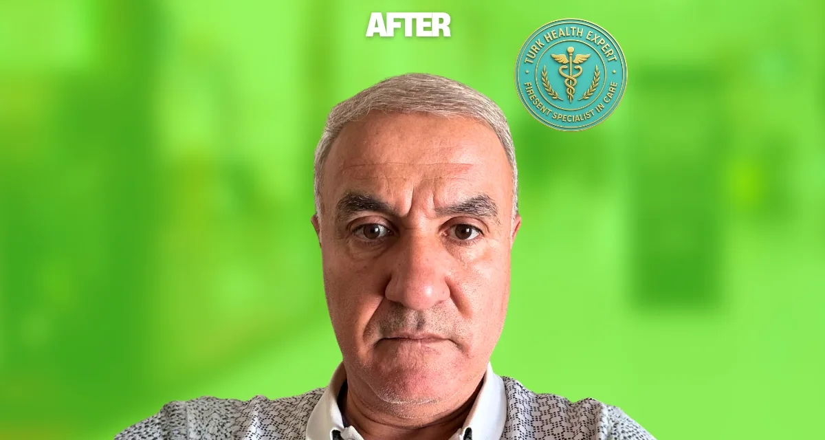 Après DHI sans rasage Istanbul 12 mois — Bekir 60 ans Bruxelles, résultat naturel