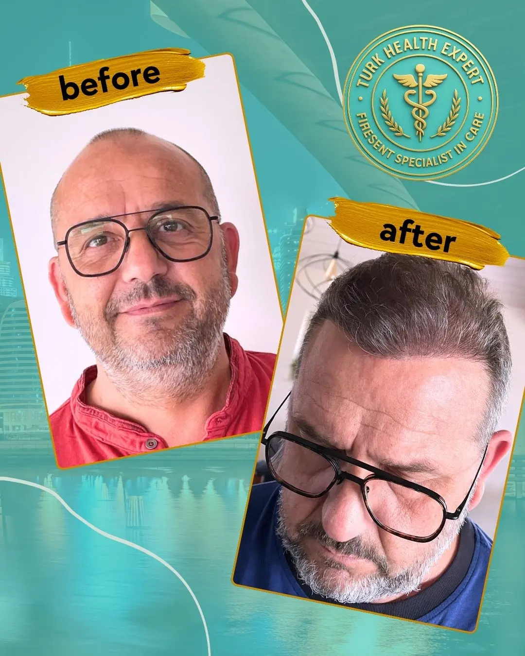 avant et apres — greffe de cheveux DHI stylo Choi à Istanbul, chirurgien principal