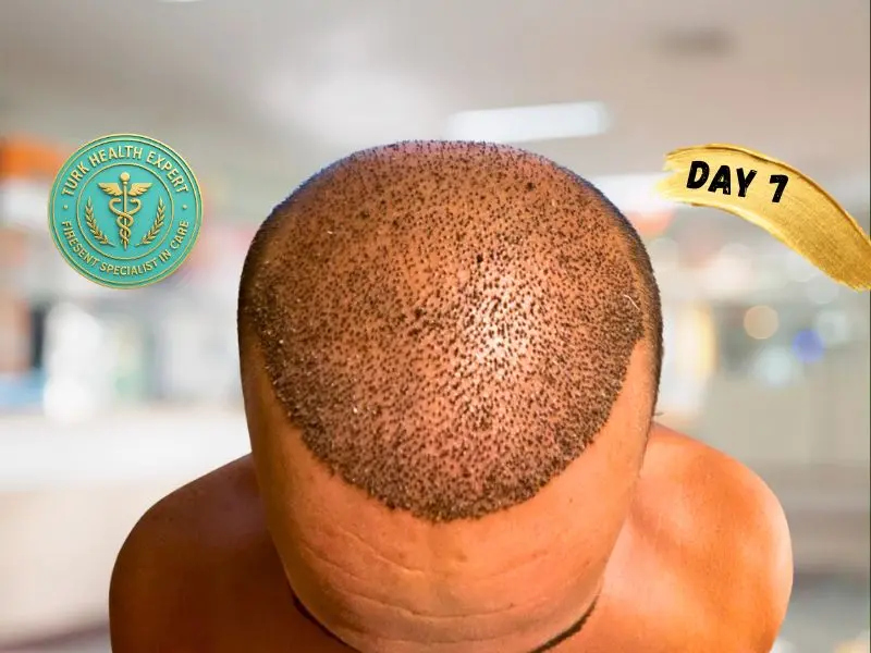Résultat greffe de cheveux Turquie — Mois 1 : phase de shock loss normale