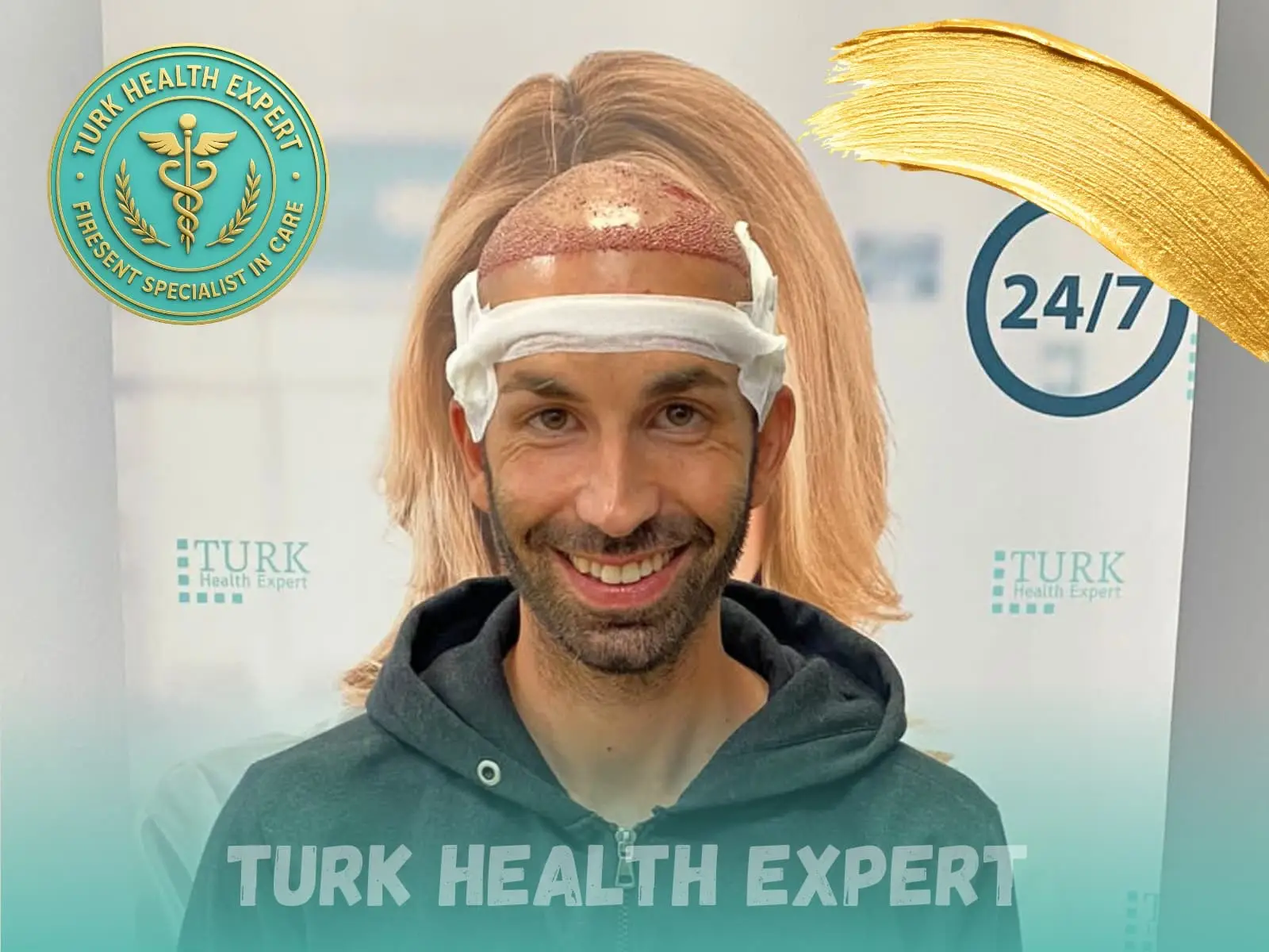 Before hair transplant — Norwood 4, DHI Gold, Turk Health Expert Istanbul