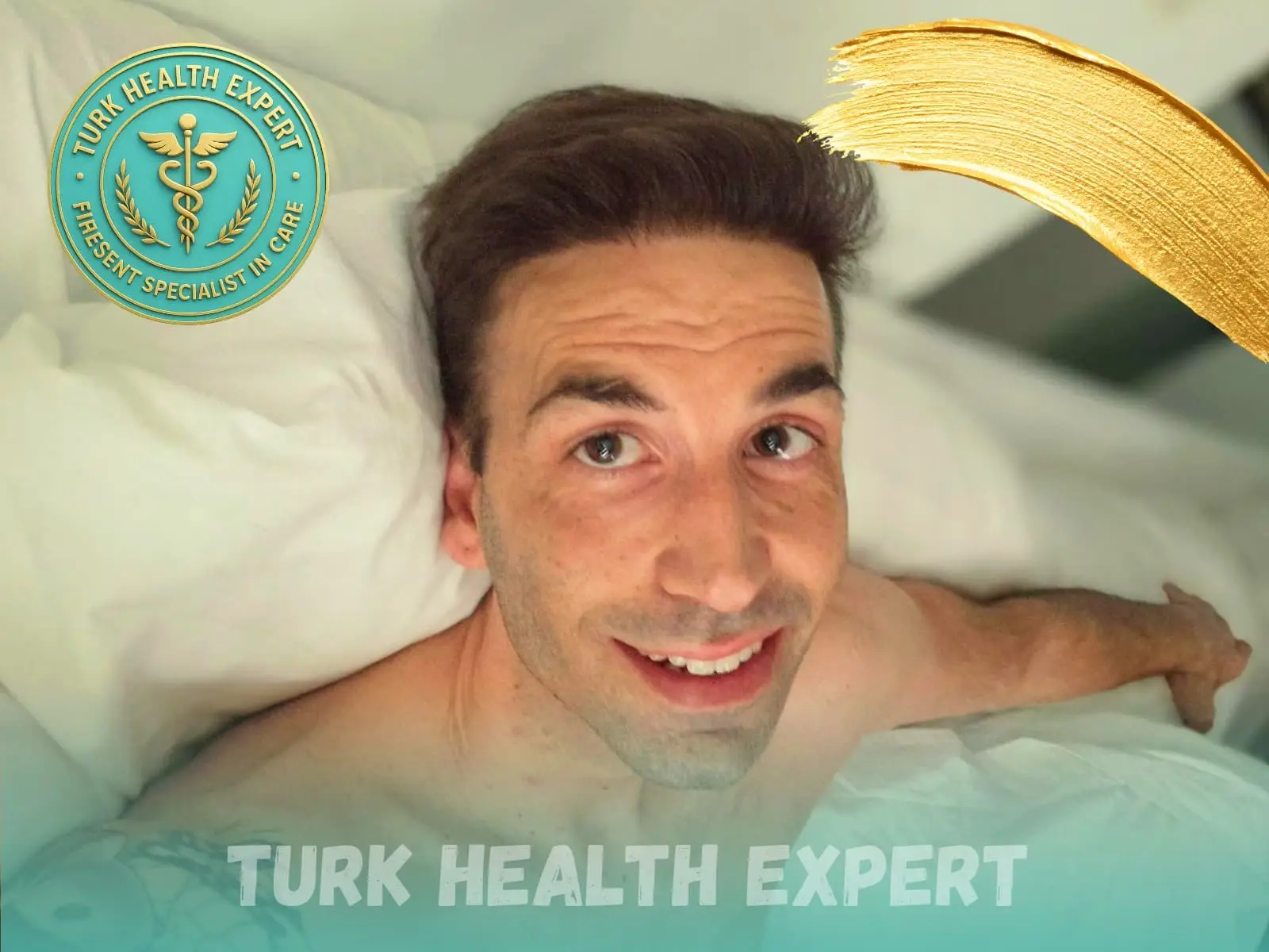 After hair transplant — 06 months, 4,200 grafts DHI, Turk Health Expert Istanbul