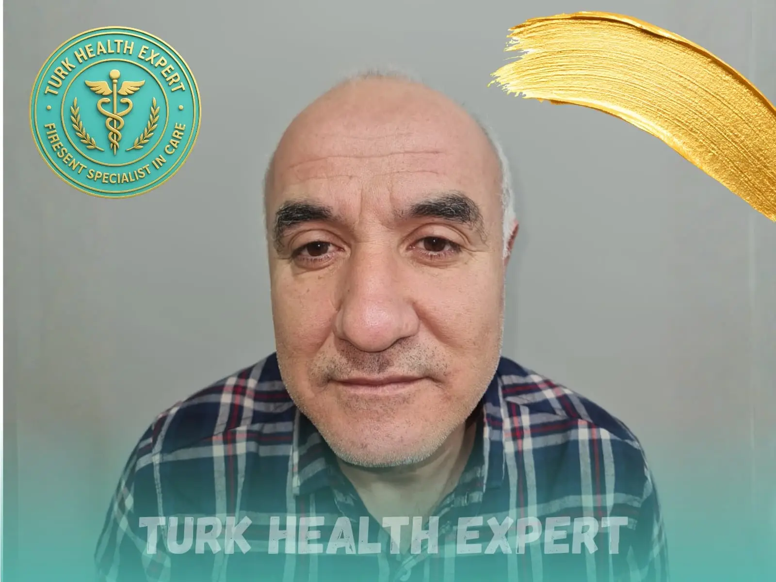 Before hair transplant — Norwood 4, DHI Gold, Turk Health Expert Istanbul