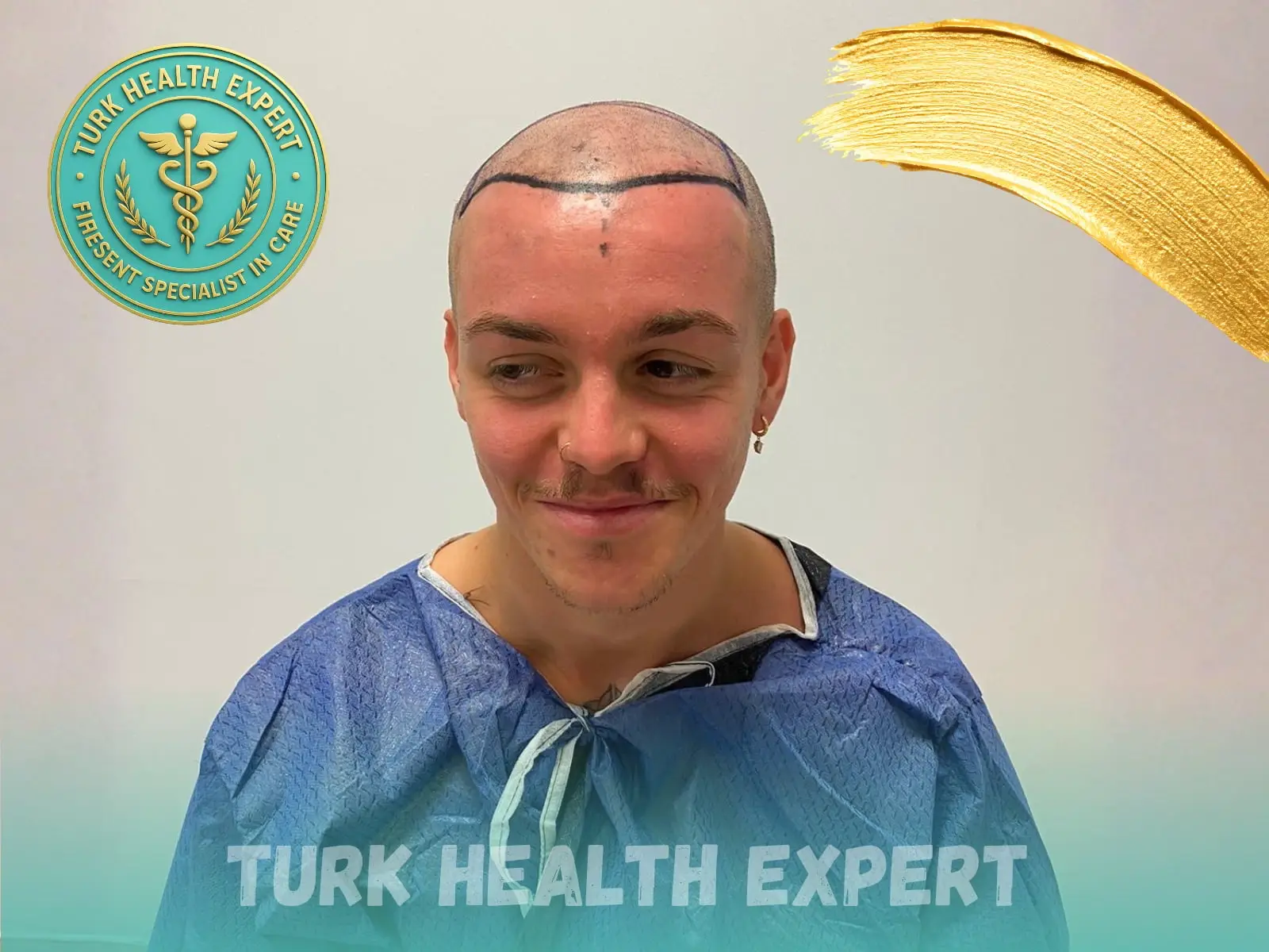 Before hair transplant — Norwood 4, DHI Gold, Turk Health Expert Istanbul