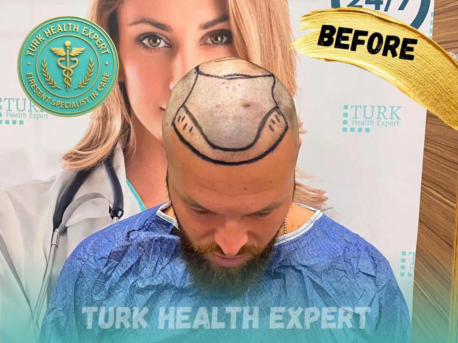 Before hair transplant — Norwood 4, DHI Gold, Turk Health Expert Istanbul
