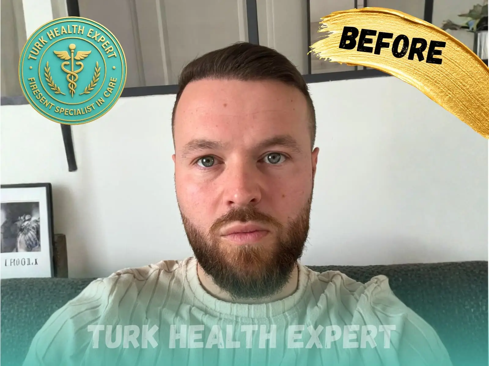 After hair transplant — 14 months, 3,200 grafts DHI, Turk Health Expert Istanbul