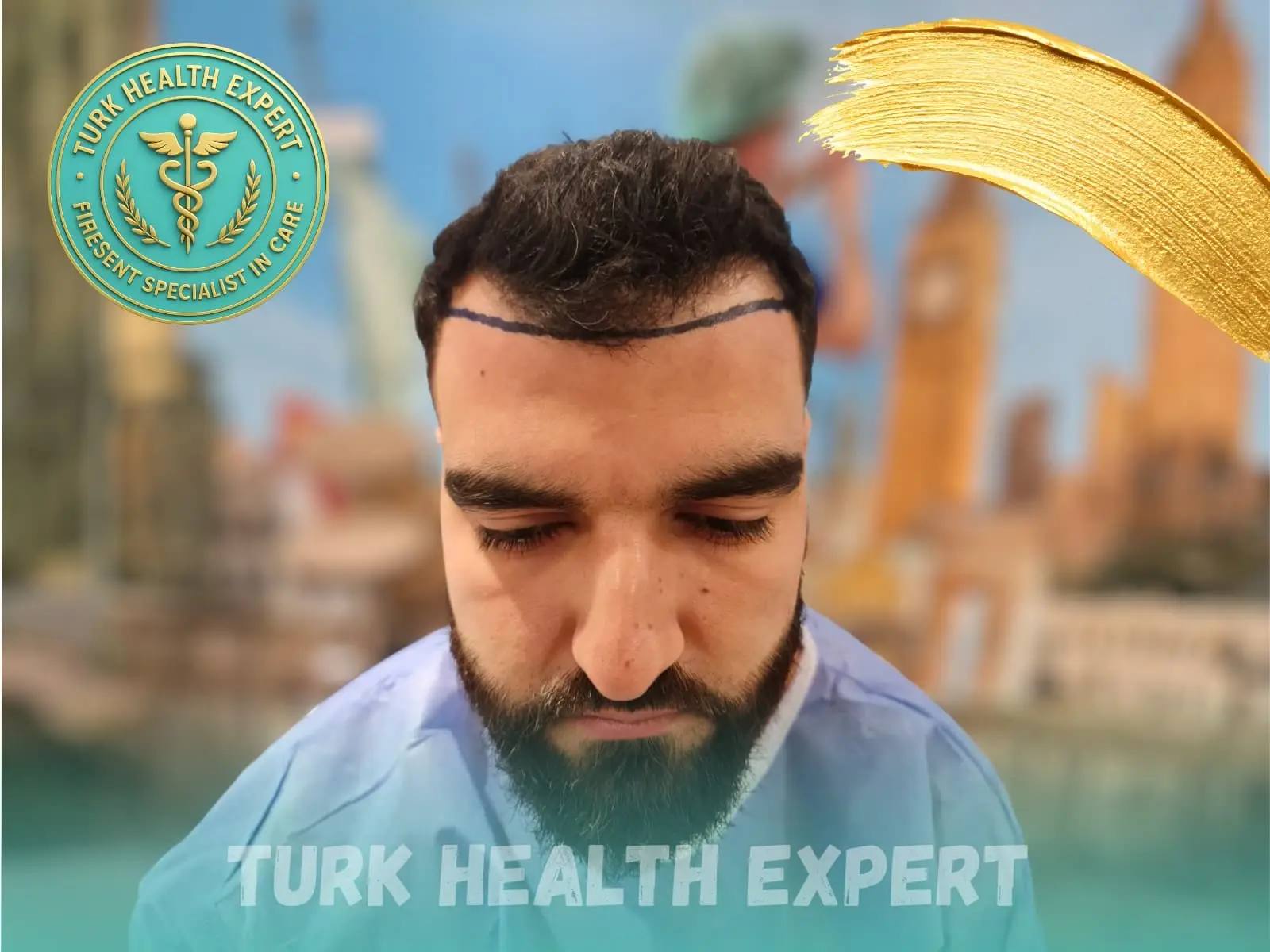 Before hair transplant — Norwood 4, DHI Gold, Turk Health Expert Istanbul