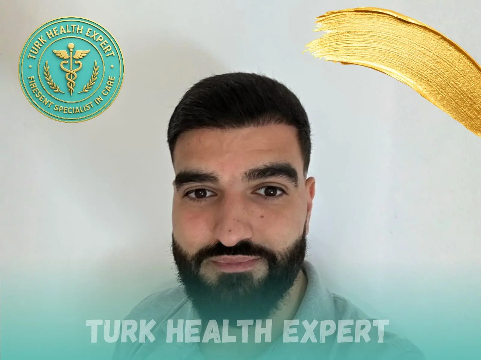 After hair transplant — 14 months, 3,200 grafts DHI, Turk Health Expert Istanbul