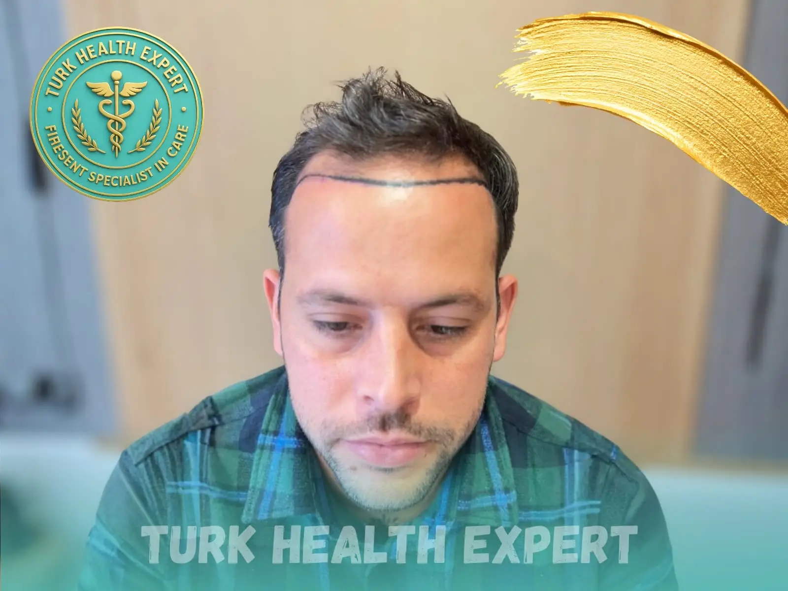 Before hair transplant — Norwood 4, DHI Gold, Turk Health Expert Istanbul