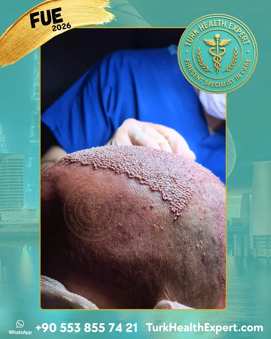 Dr. Zekeriya Türk realizando trasplante capilar DHI en Turquía — Turk Health Expert