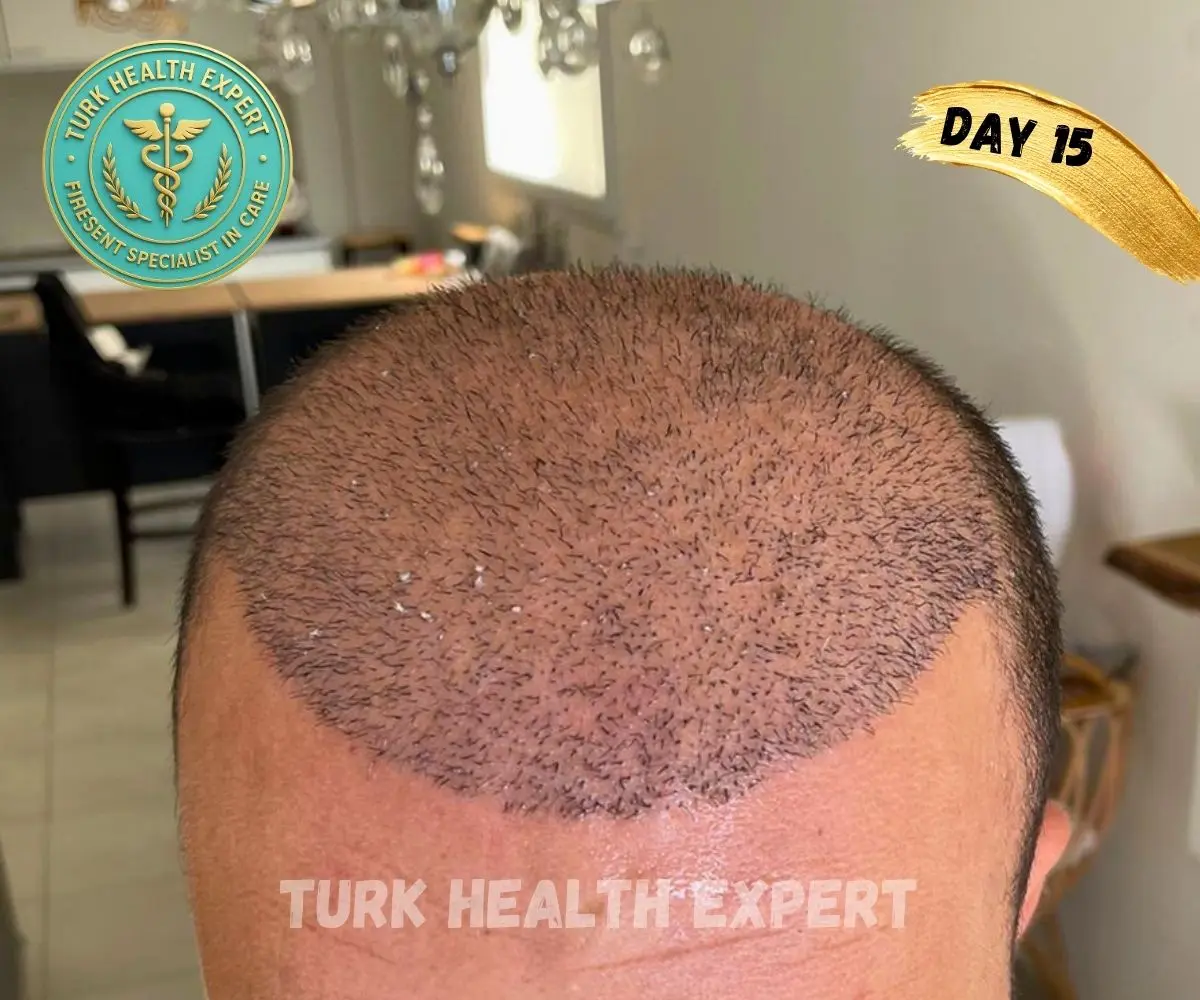 Résultat greffe de cheveux Turquie — Mois 1 : phase de shock loss normale