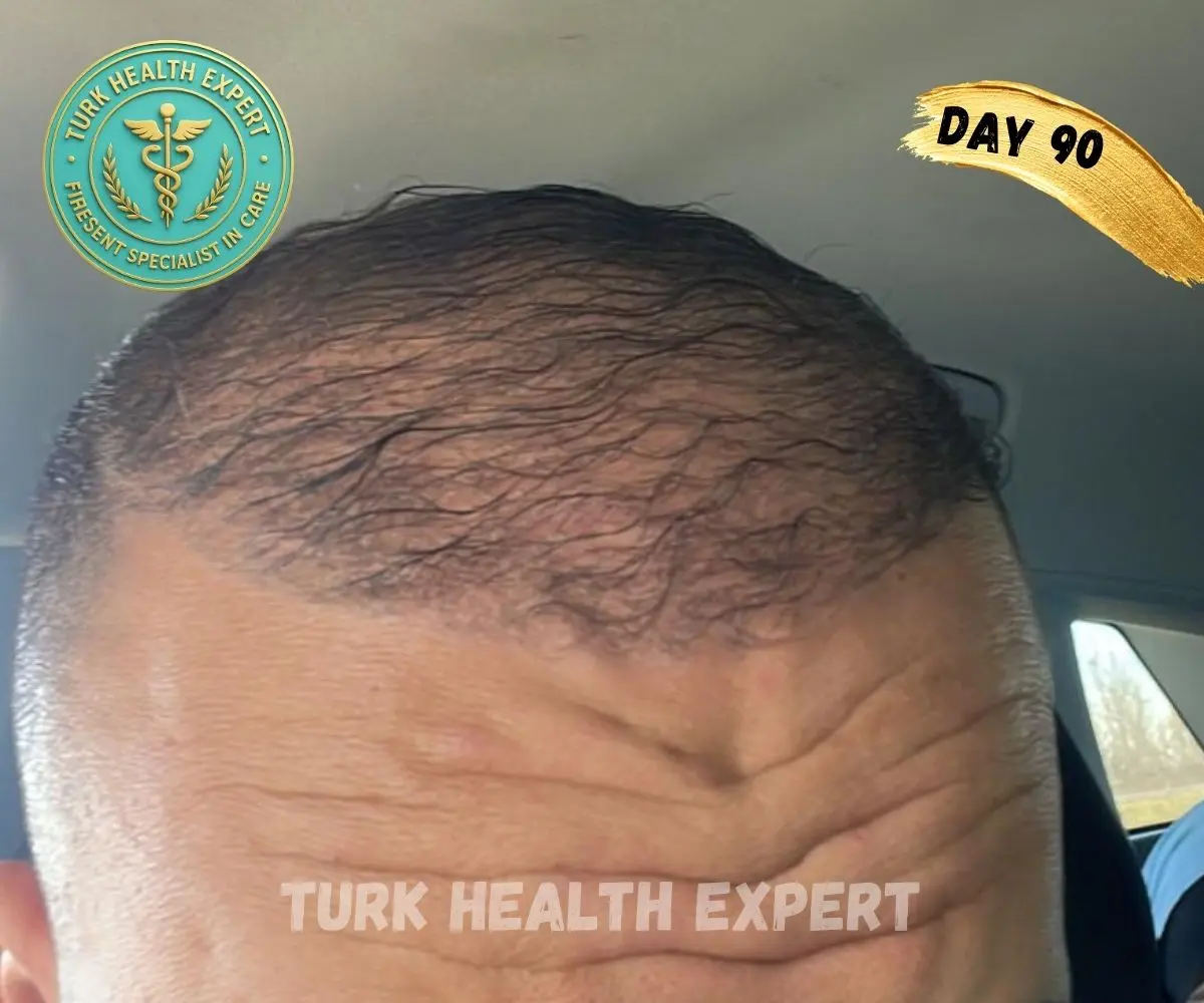 Résultat greffe de cheveux Turquie — Mois 3 : premiers cheveux qui repoussent