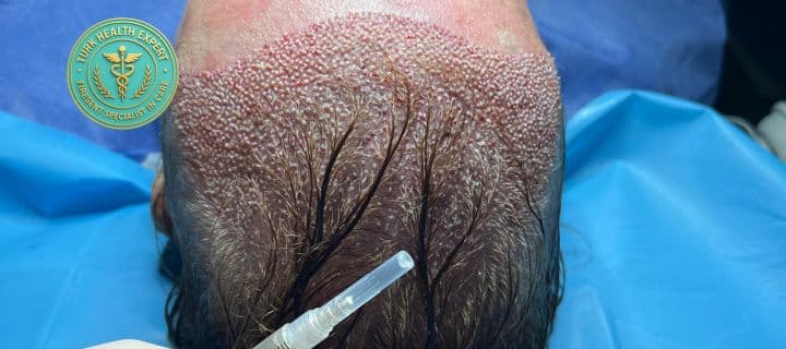 DHI no shave hair transplant analysis