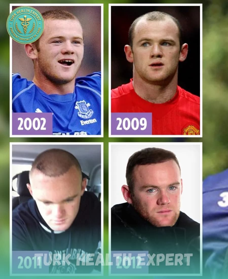 wayne rooney hair transplant before after
