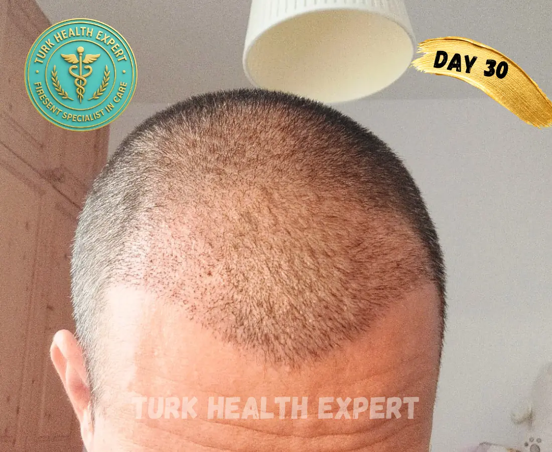 DHI Turquía día 7 — costras normales zona receptora