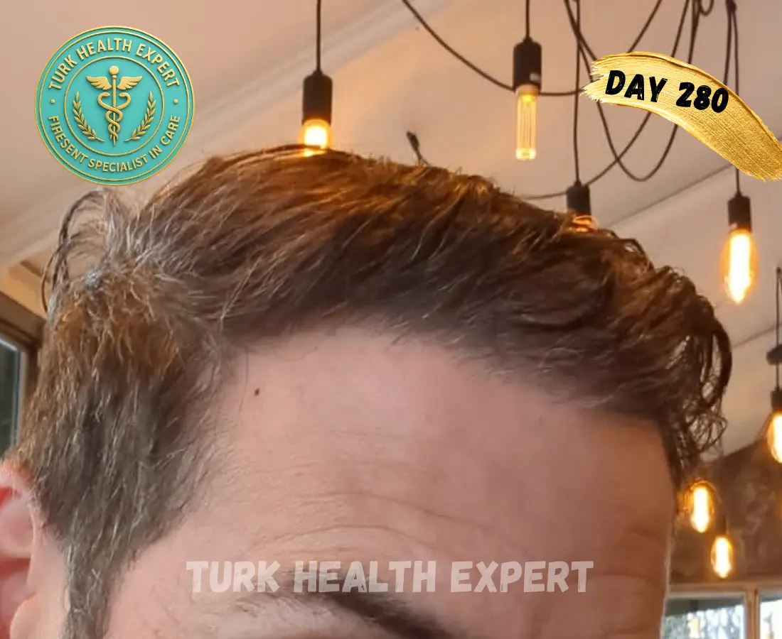 DHI Turquía día 7 — costras normales zona receptora