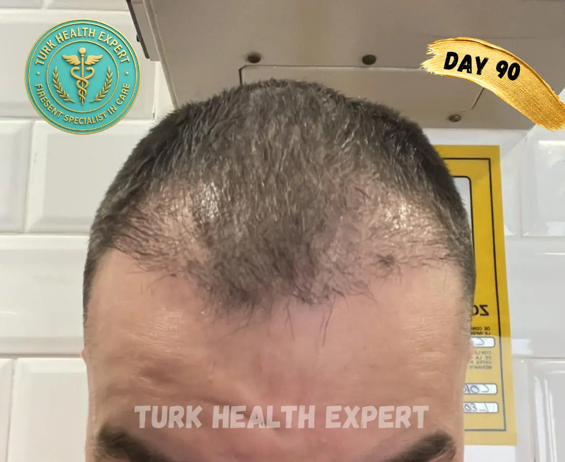 DHI Turquía día 7 — costras normales zona receptora