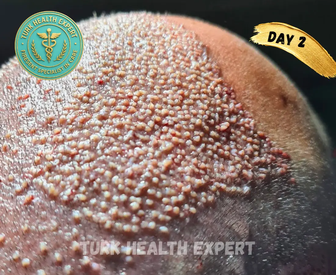 DHI Turquía día 7 — costras normales zona receptora